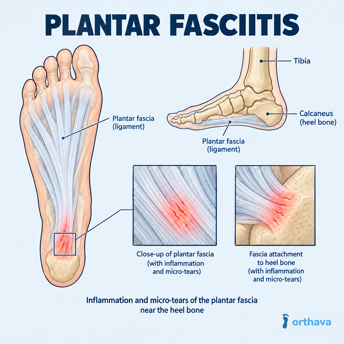 Where plantar fasciitis pain is felt