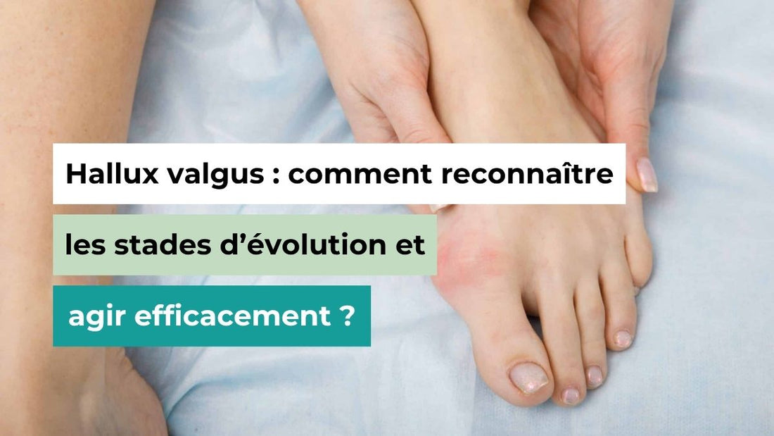 Hallux valgus : comment reconnaître les stades d’évolution et agir efficacement ? - Semello.fr