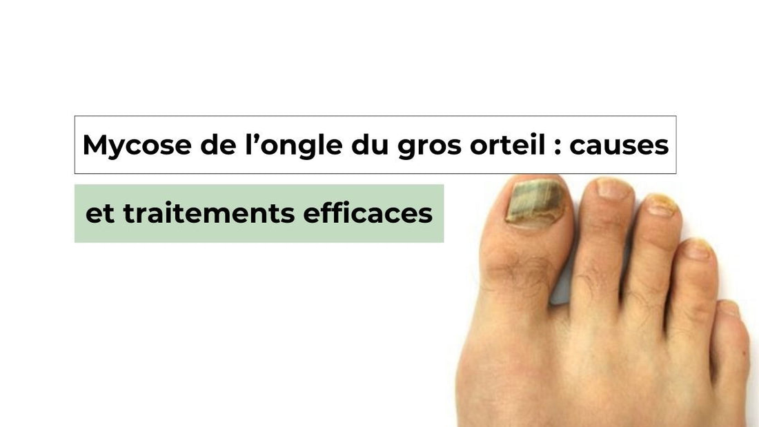 Mycose de l’Ongle du Gros Orteil : Symptômes, Causes et Traitements - Semello.fr