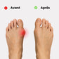 Soft discreet bunion corrector worn over the big toe joint inside a shoe