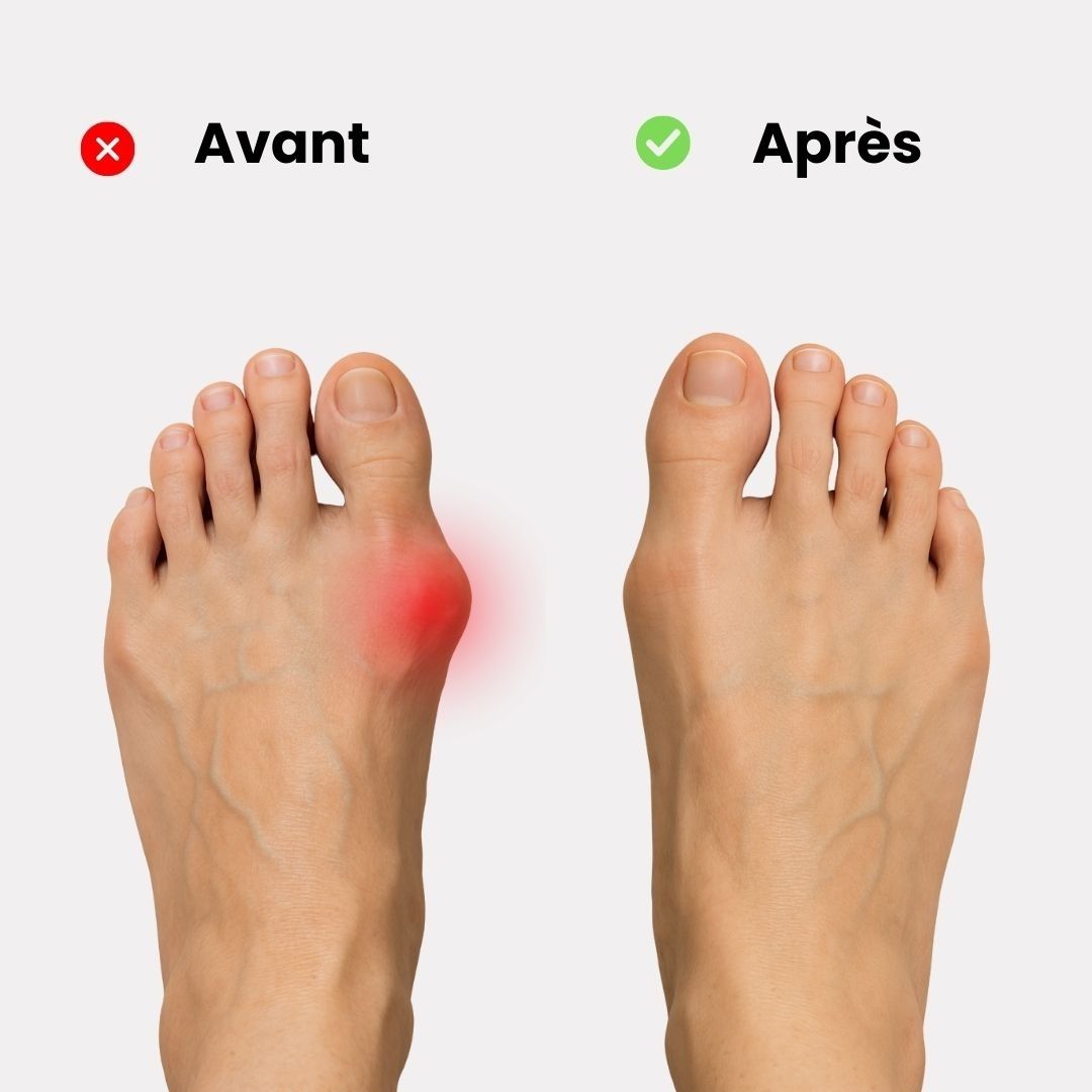 Soft discreet bunion corrector worn over the big toe joint inside a shoe