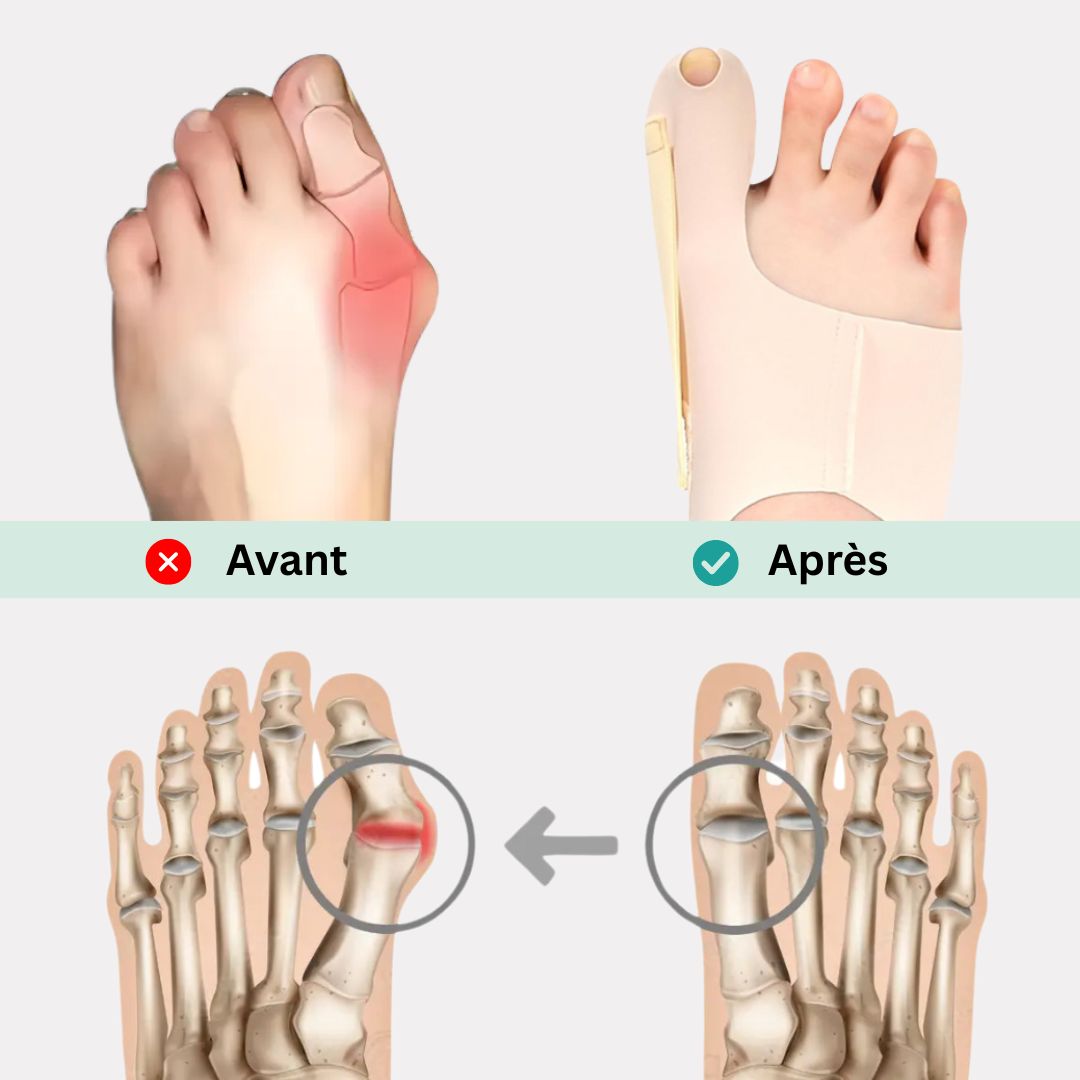 Ultra-thin bunion correction sock worn under the big toe joint inside any shoe