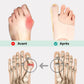 Lightweight correction sleeve worn over the bunion to realign the big toe