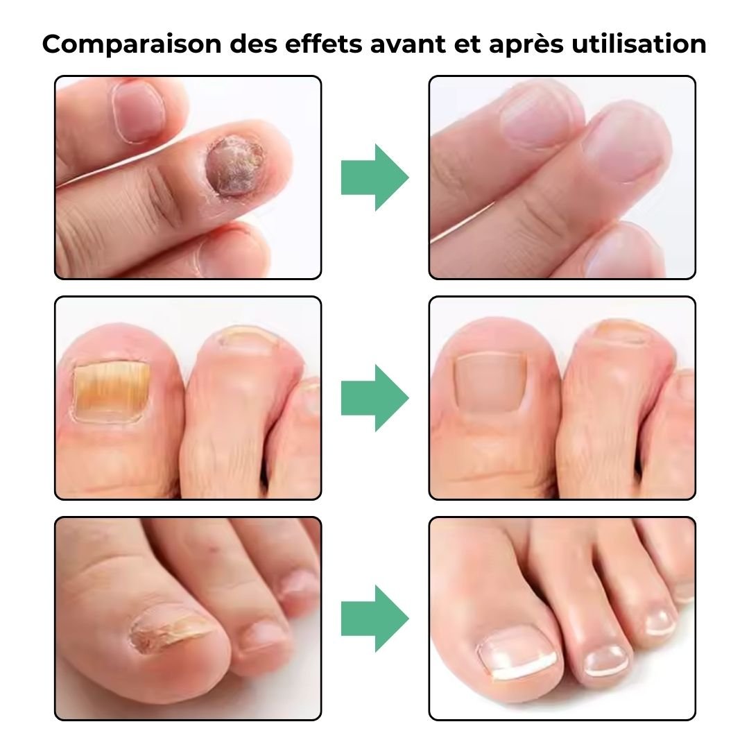 Handheld UV device held over the toenail to treat nail fungus at home