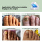 Clip-on UV lamp positioned over the toenail for painless fungus treatment