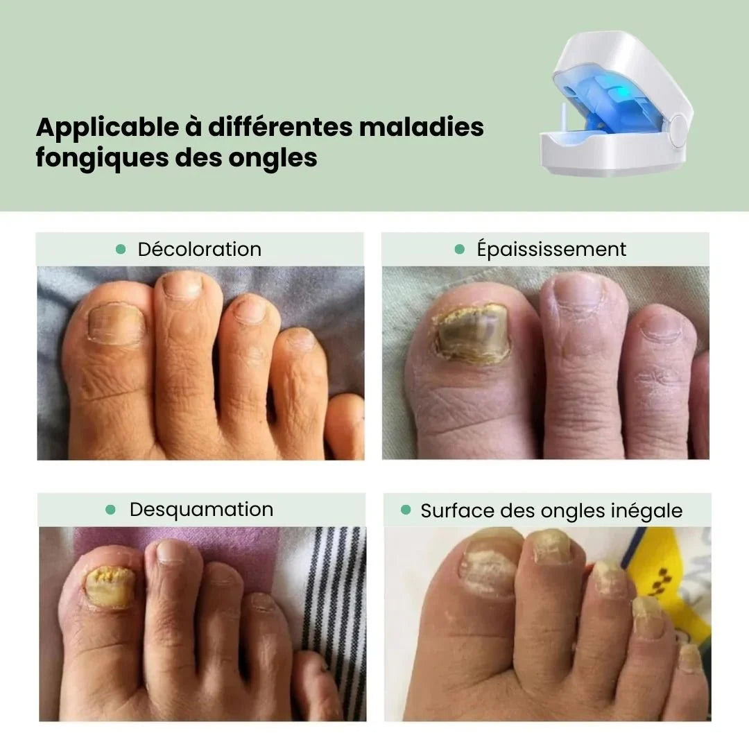 Clip-on UV lamp positioned over the toenail for painless fungus treatment