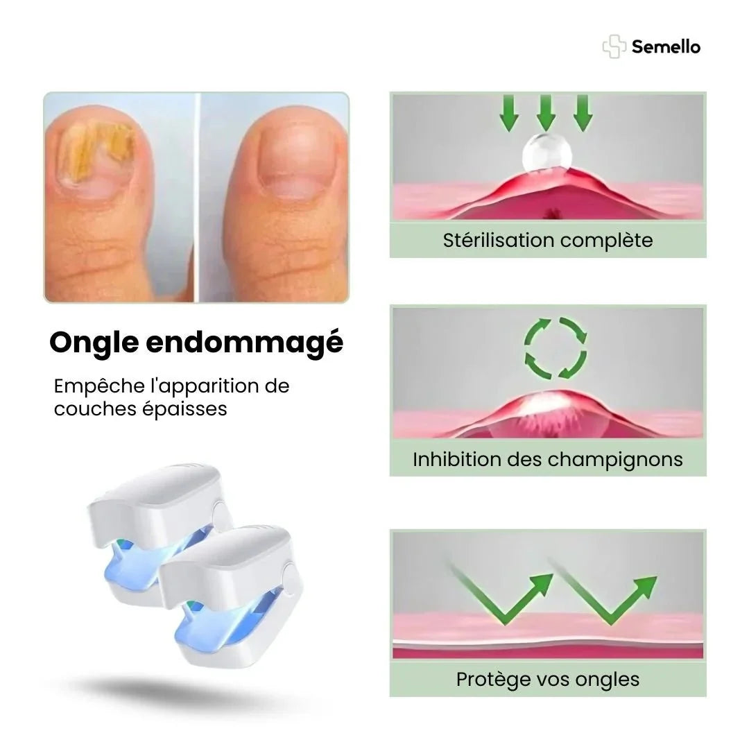 Clip-on UV lamp positioned over the toenail for painless fungus treatment