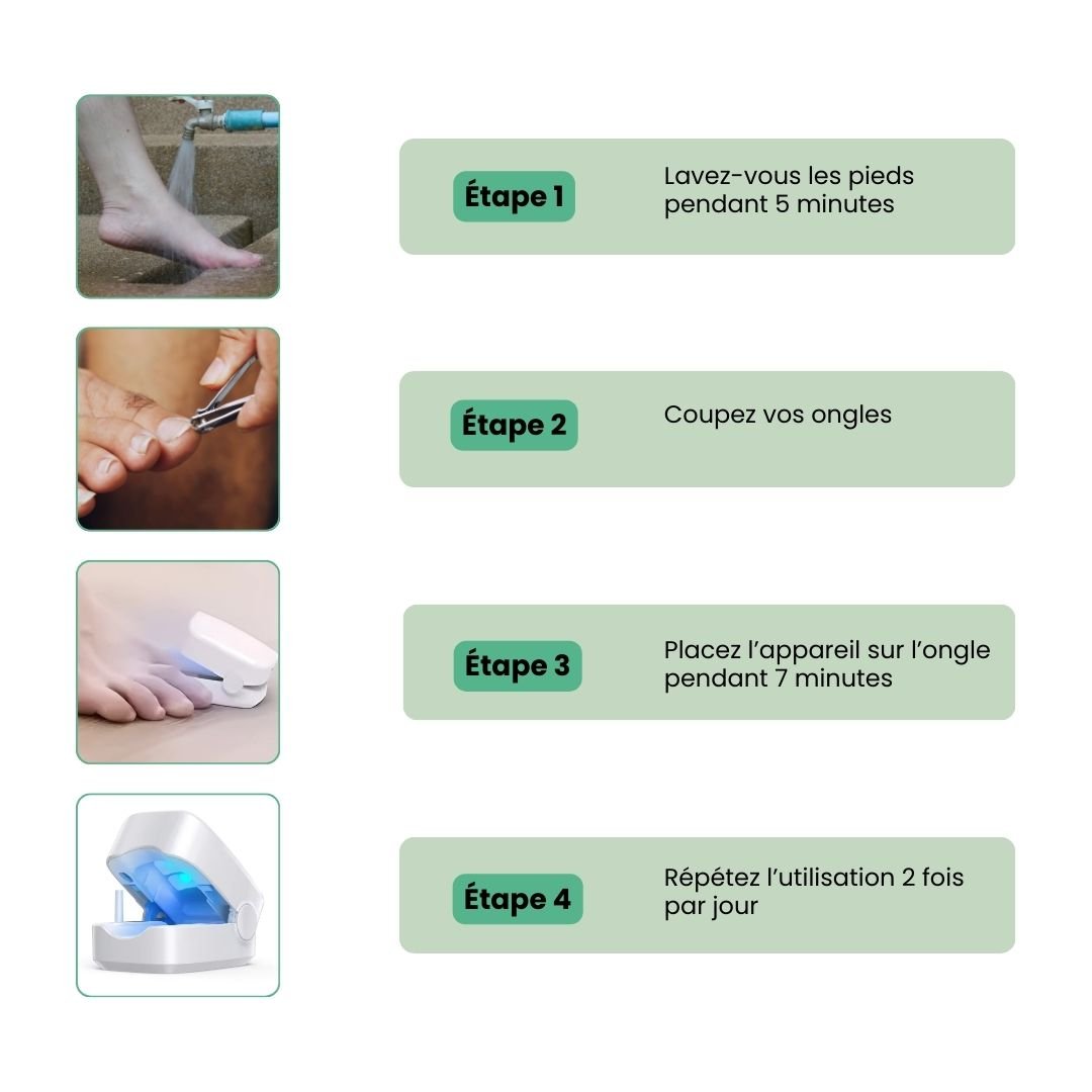 Clip-on UV lamp positioned over the toenail for painless fungus treatment