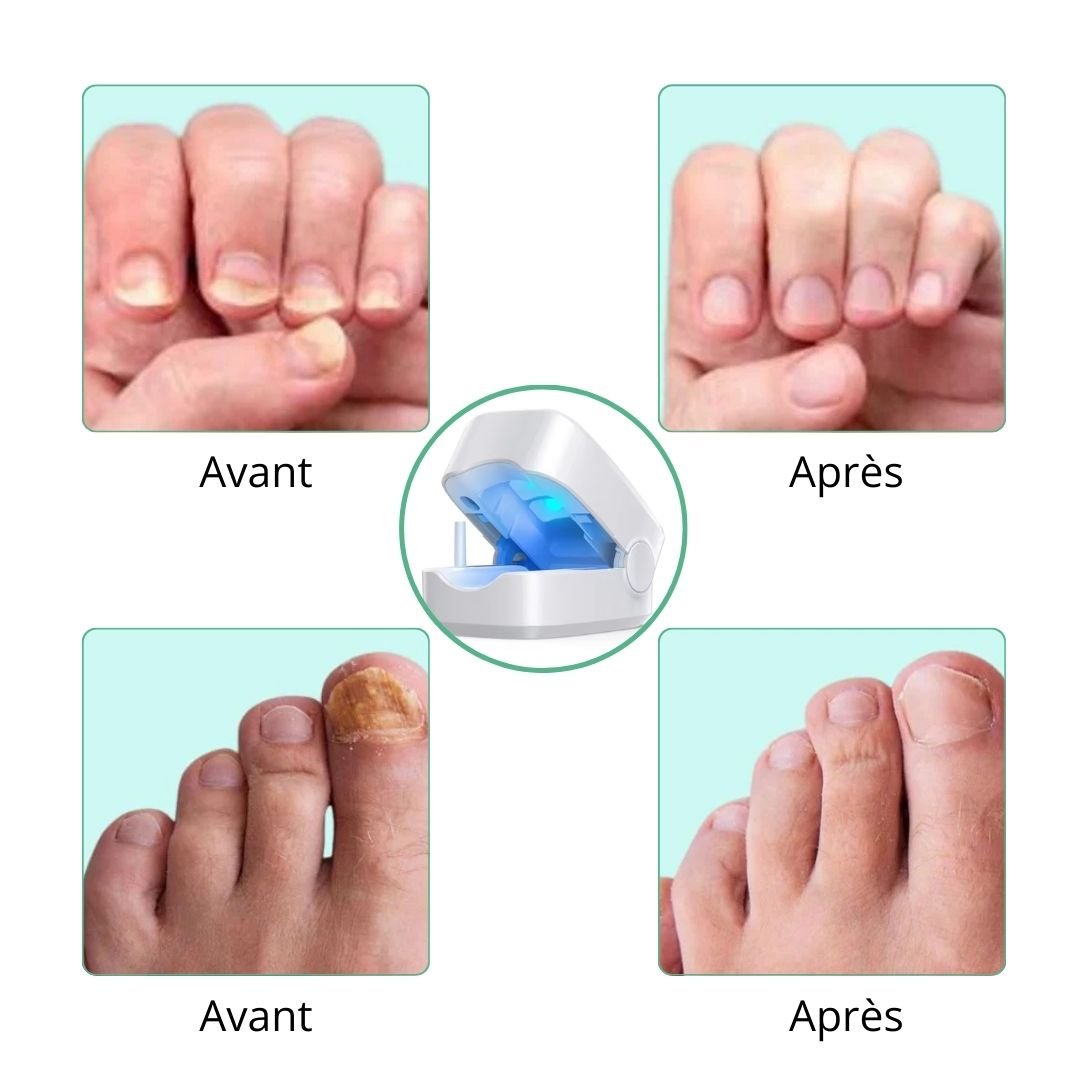 Clip-on UV lamp positioned over the toenail for painless fungus treatment