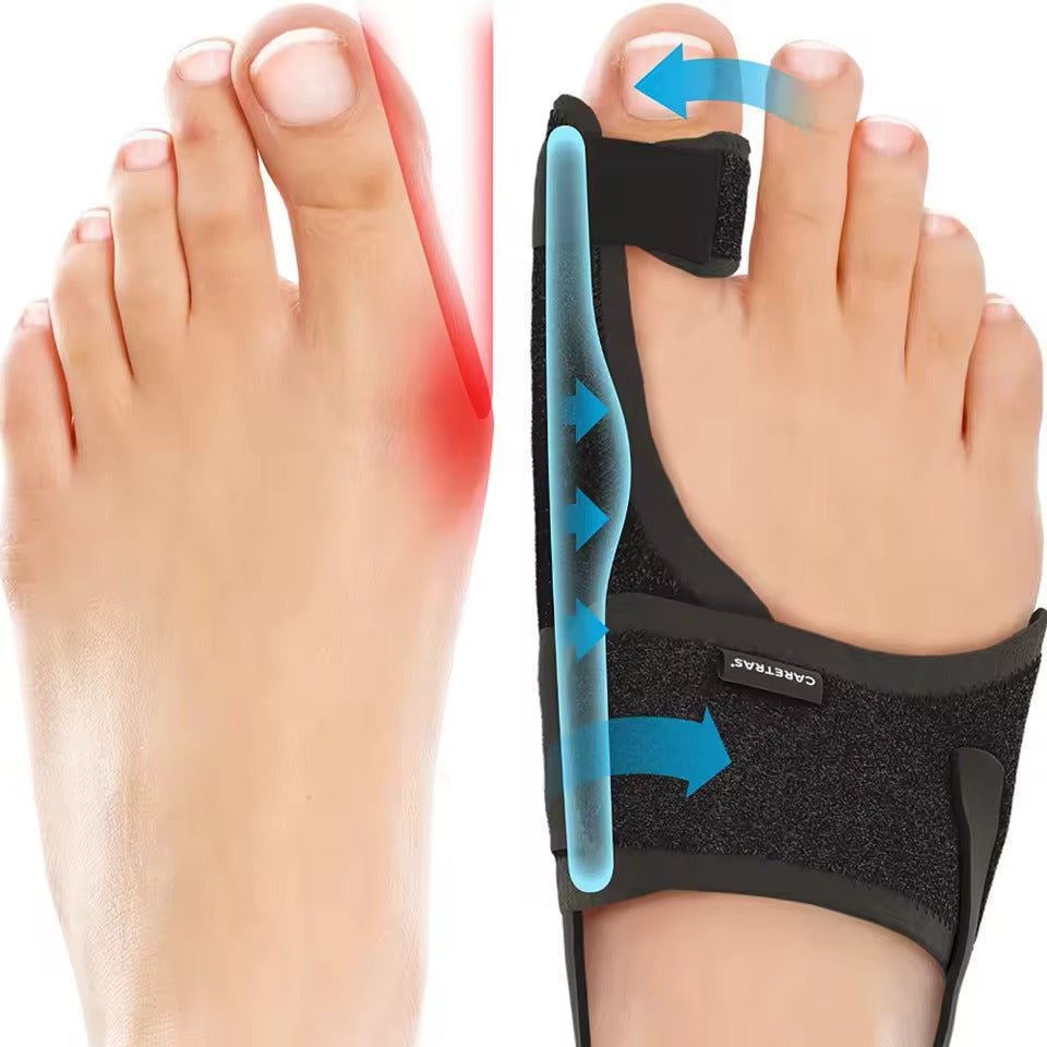 Adjustable night splint strapped across the forefoot to realign the big toe
