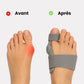 Hinged bunion splint worn over the big toe joint, letting the foot flex while it corrects