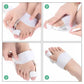 Bunion night splint strapped across the forefoot to hold the big toe straight overnight
