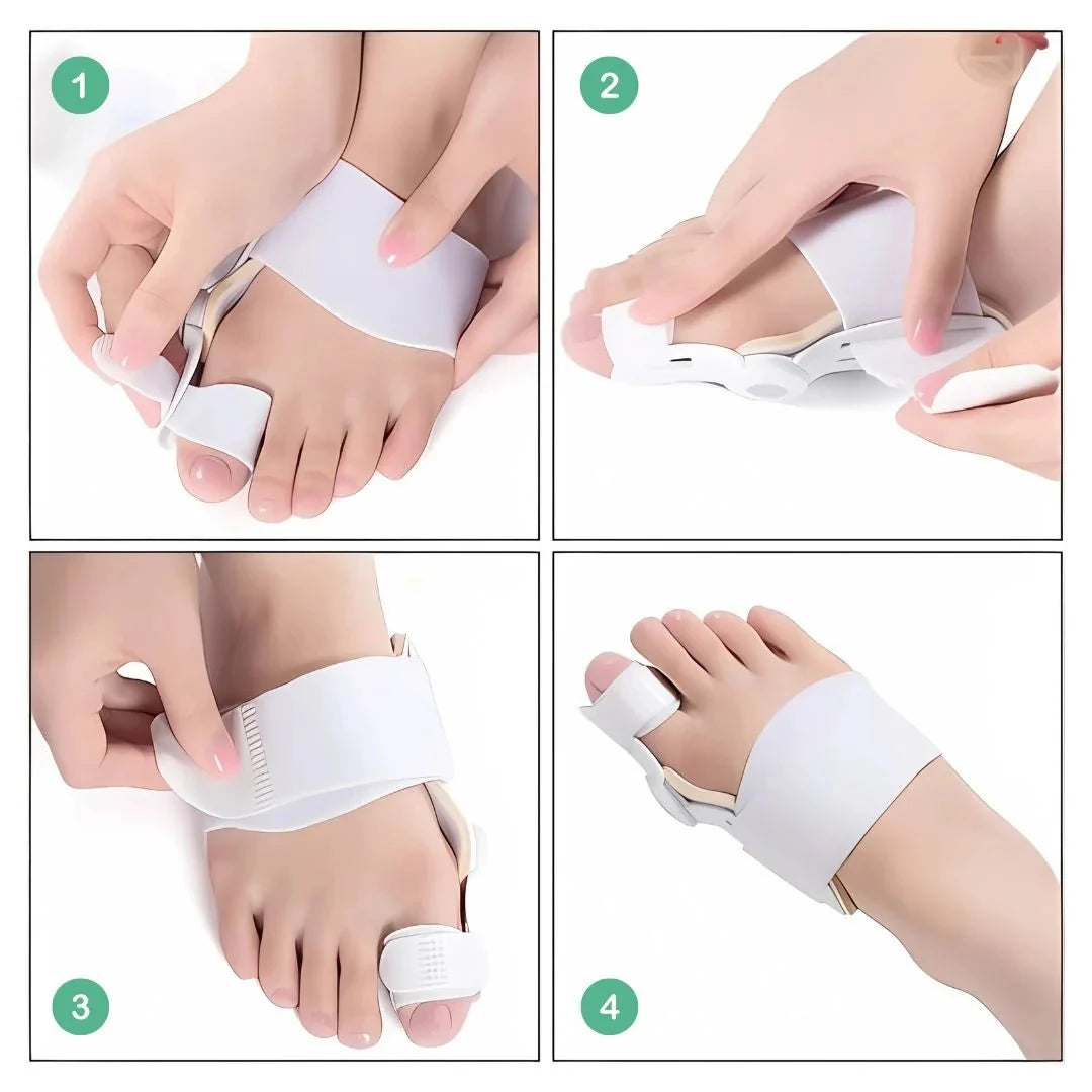 Bunion night splint strapped across the forefoot to hold the big toe straight overnight