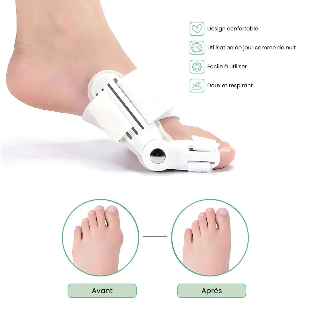 Bunion night splint strapped across the forefoot to hold the big toe straight overnight