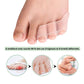 Soft silicone splint worn over the little toe to cushion and straighten it