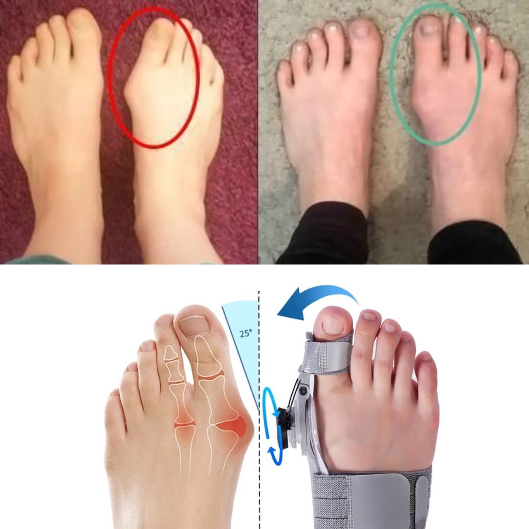 Bunion corrector strap worn over the big toe joint to hold the toe in line