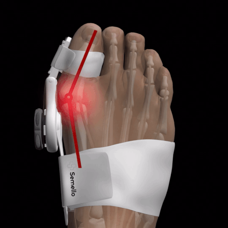 Bunion corrector strapped around the forefoot to realign the big toe