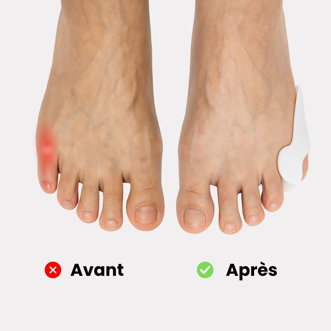 Soft silicone sleeve slipped over the little toe to cushion rubbing