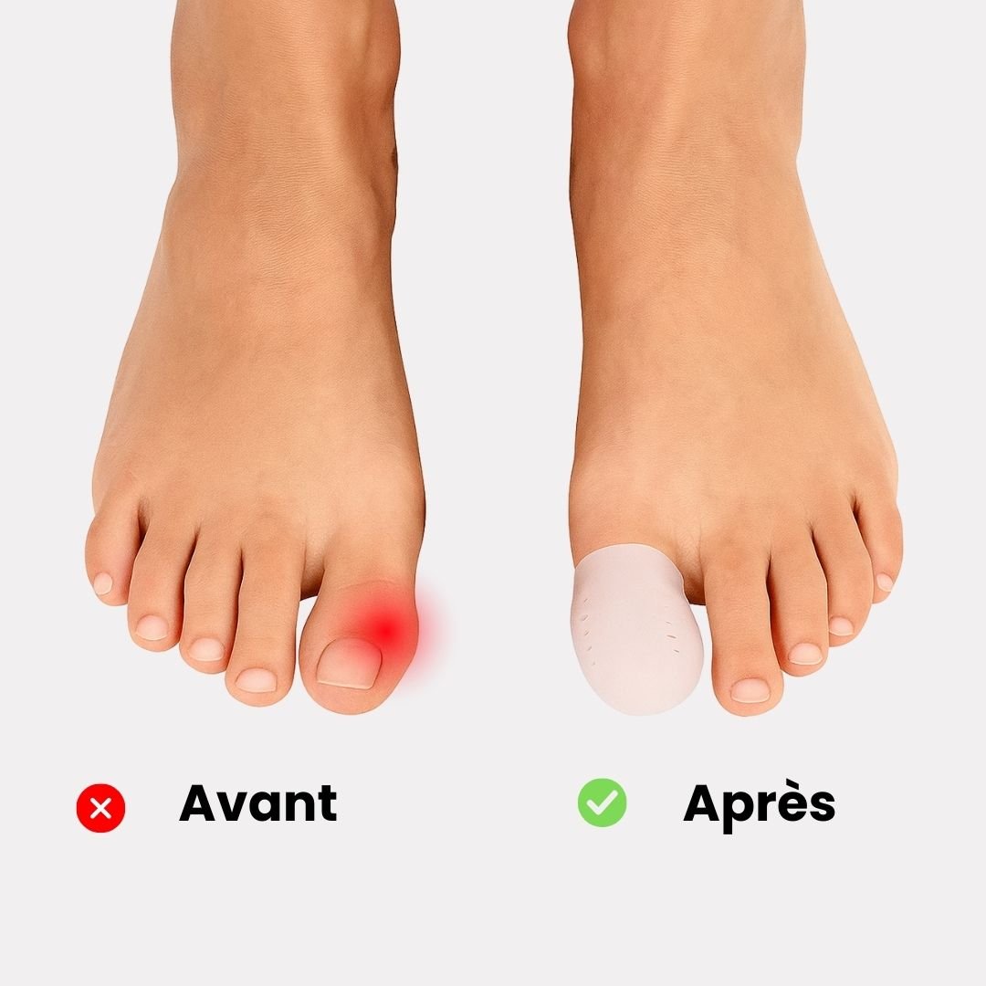 Soft sleeve worn over the big toe to cushion pressure inside the shoe