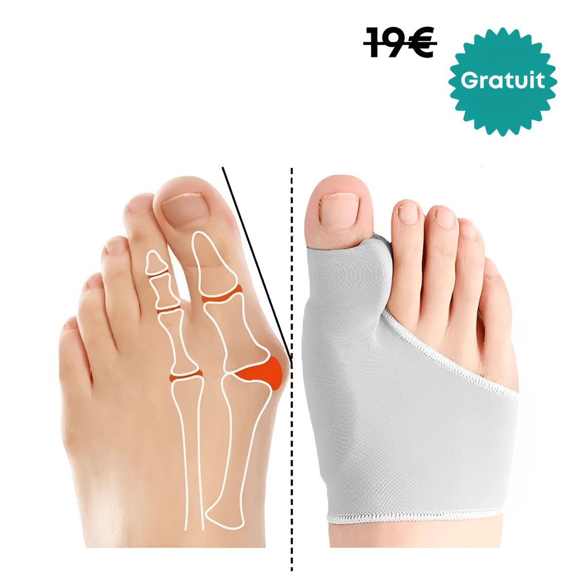Adjustable bunion corrector strapped around the forefoot to draw the big toe straight