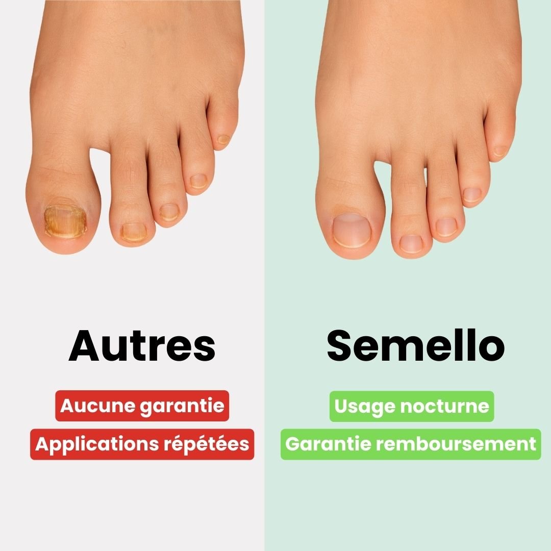 Toenail fungus kit with adhesive patches worn on the nail and a brush-tip serum