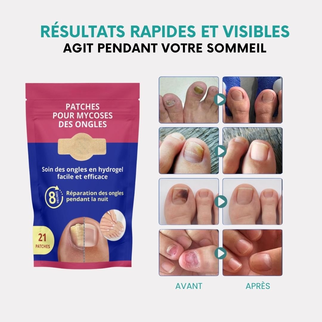 Toenail fungus kit with adhesive patches worn on the nail and a brush-tip serum