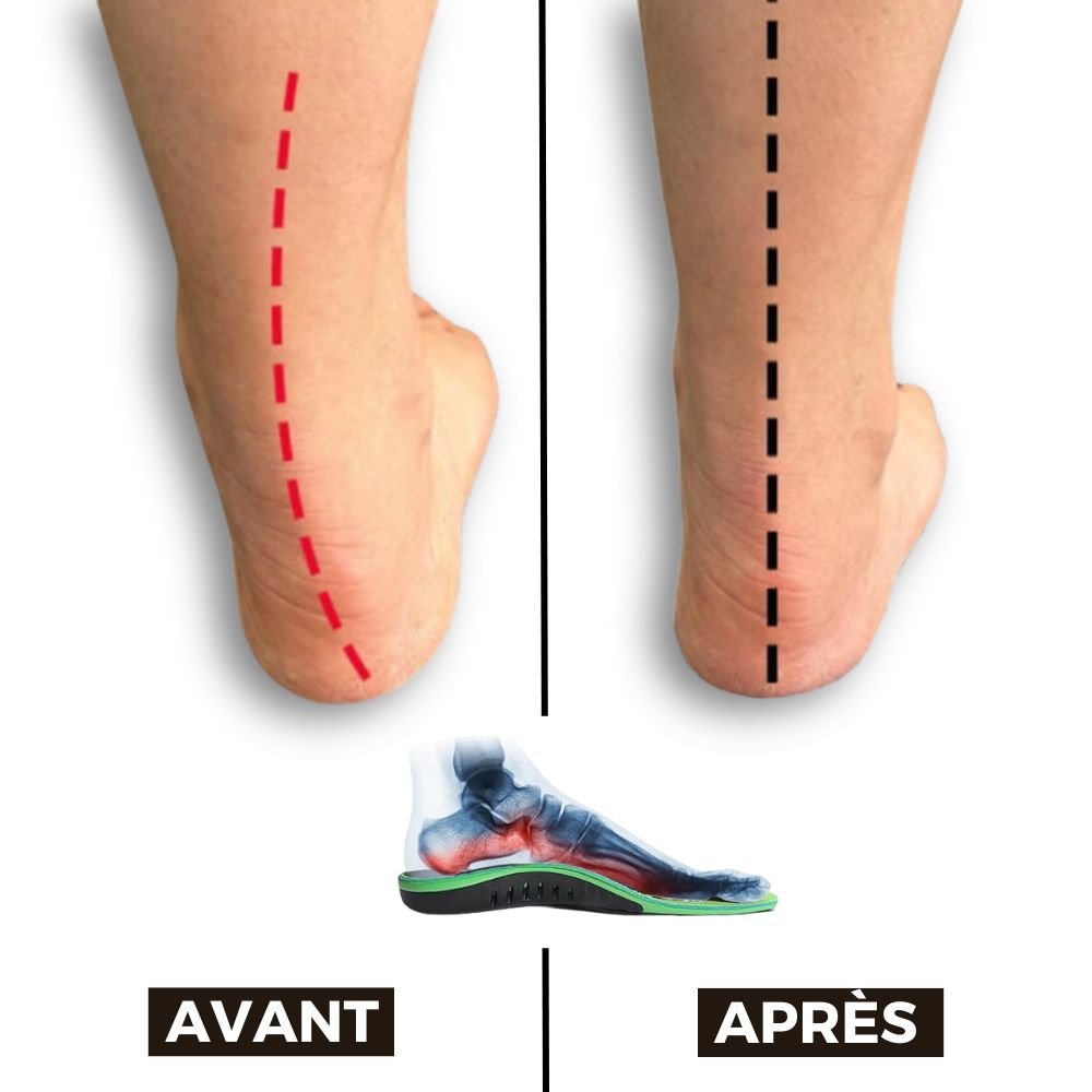 Orthopedic insoles for everyday foot pain, contoured under the arch and the heel