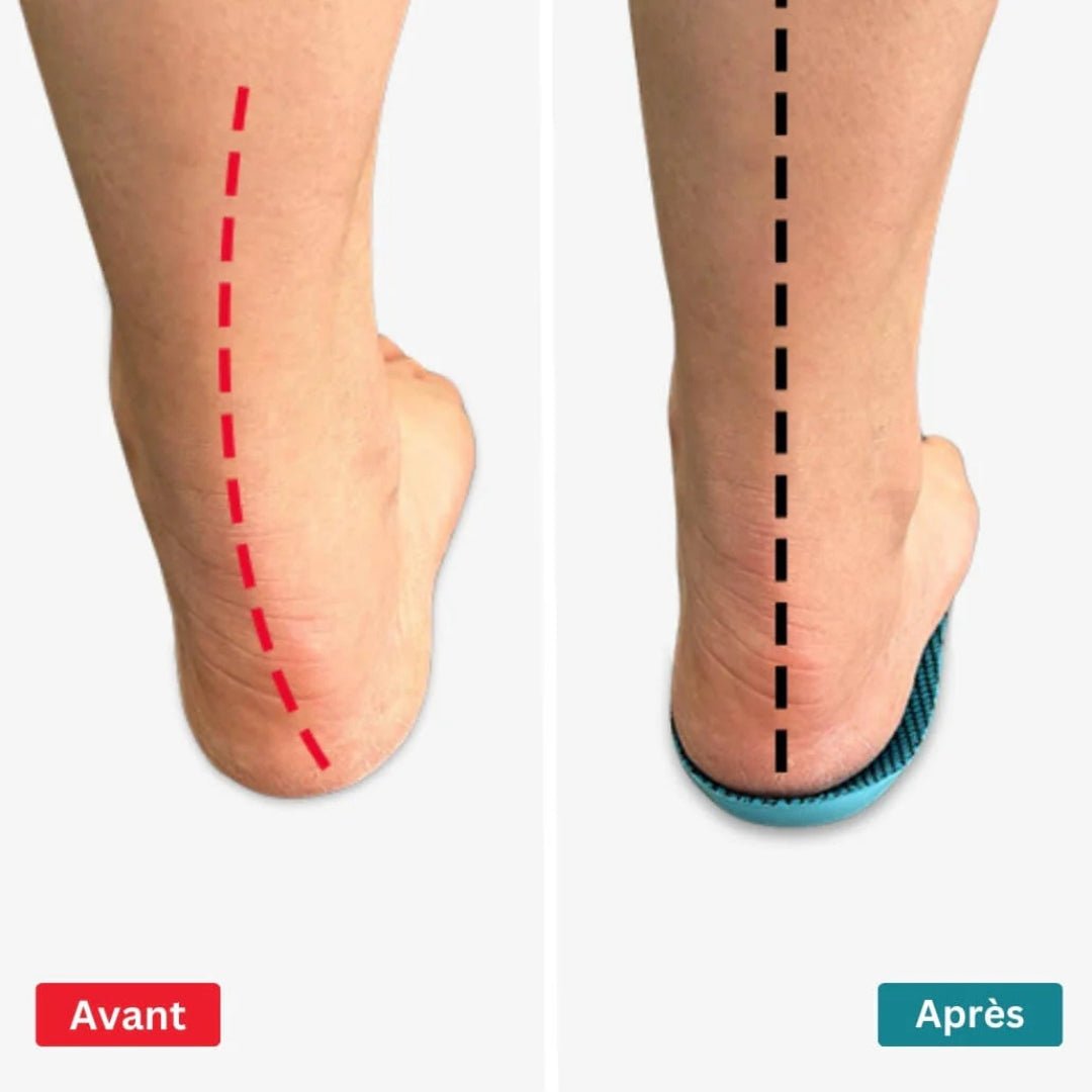 Pair of insoles shaped to relieve pressure under the bunion joint inside the shoe