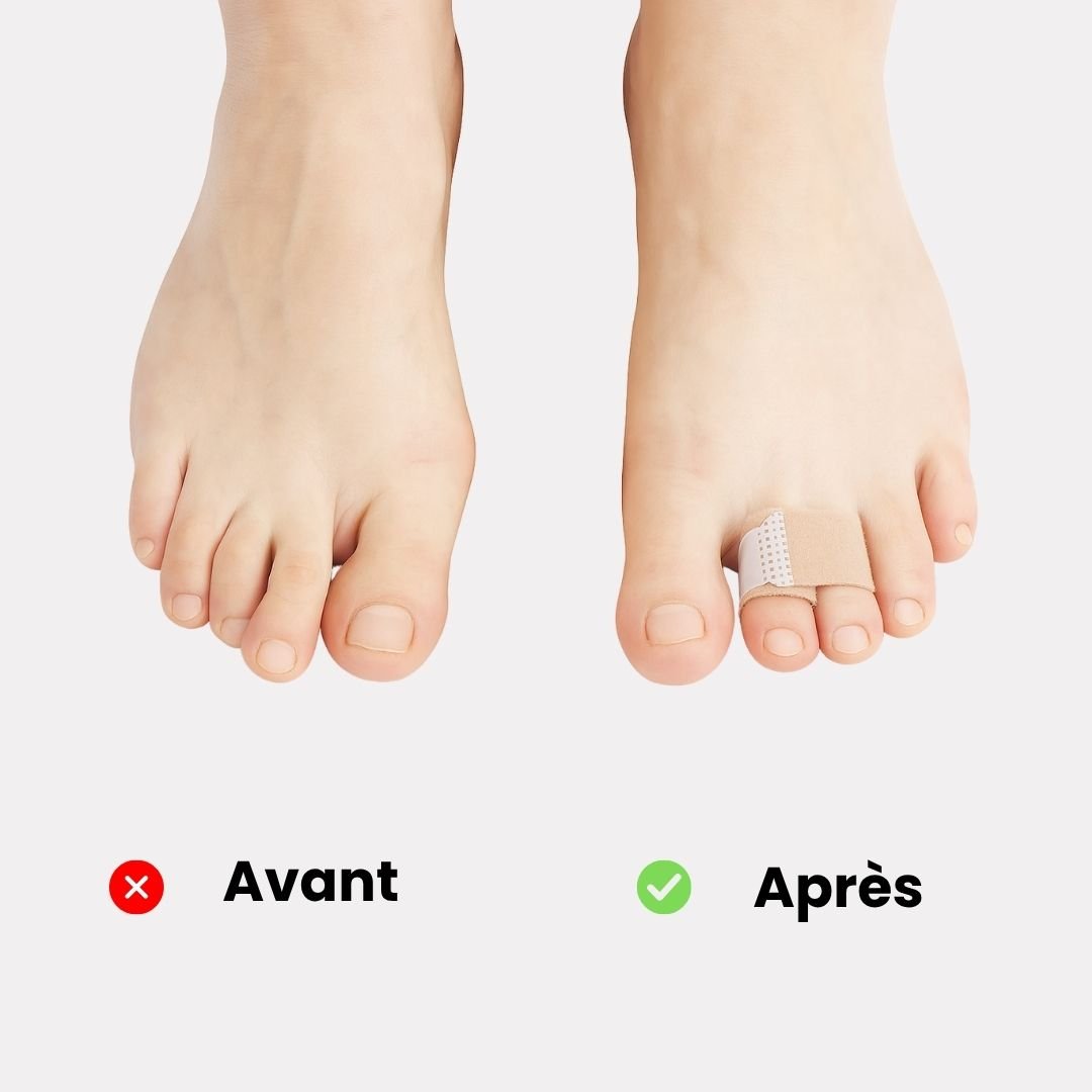 Fabric strap looped around the toes and forefoot to straighten a claw toe