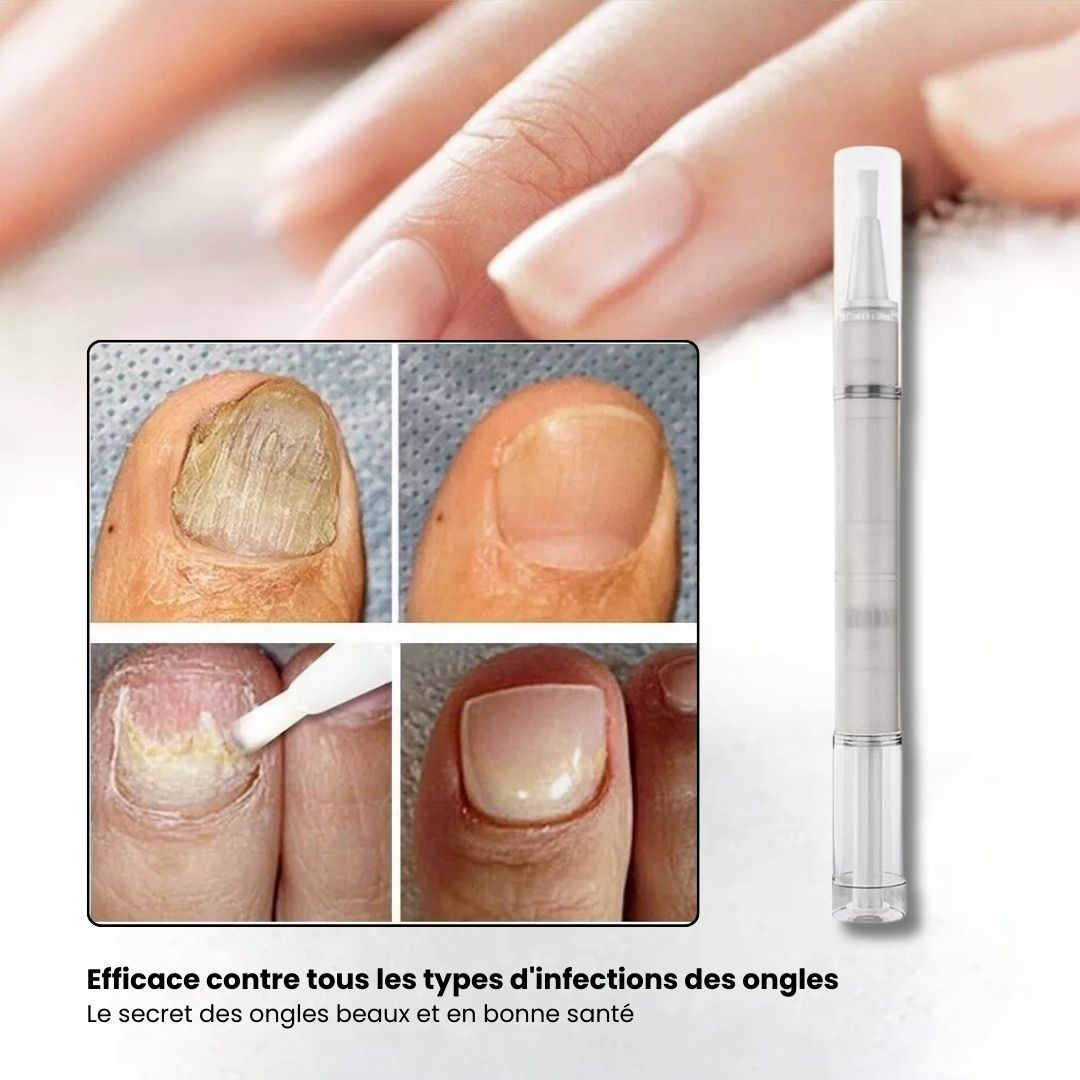 Toenail fungus serum in a slim applicator pen for brushing onto the nail