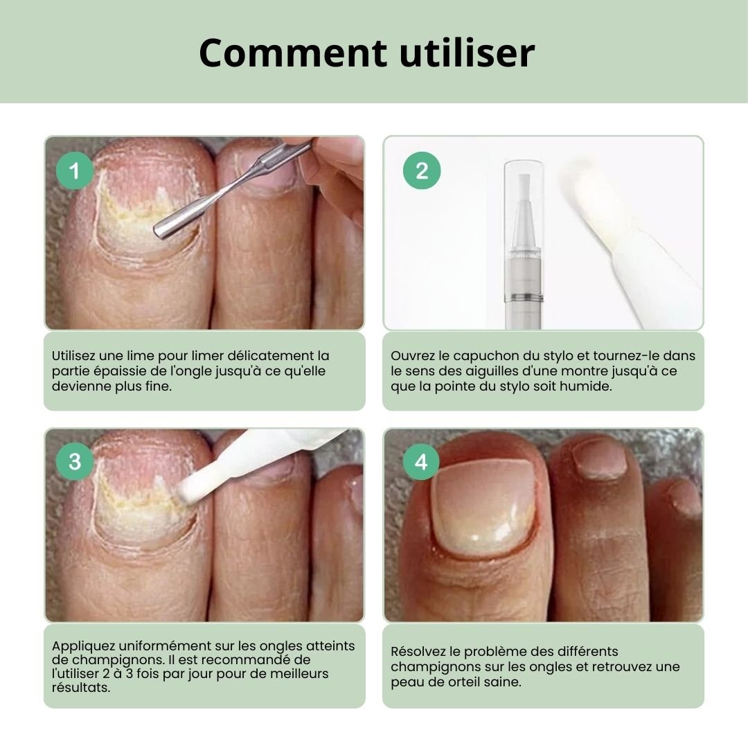 Toenail fungus serum in a slim applicator pen for brushing onto the nail