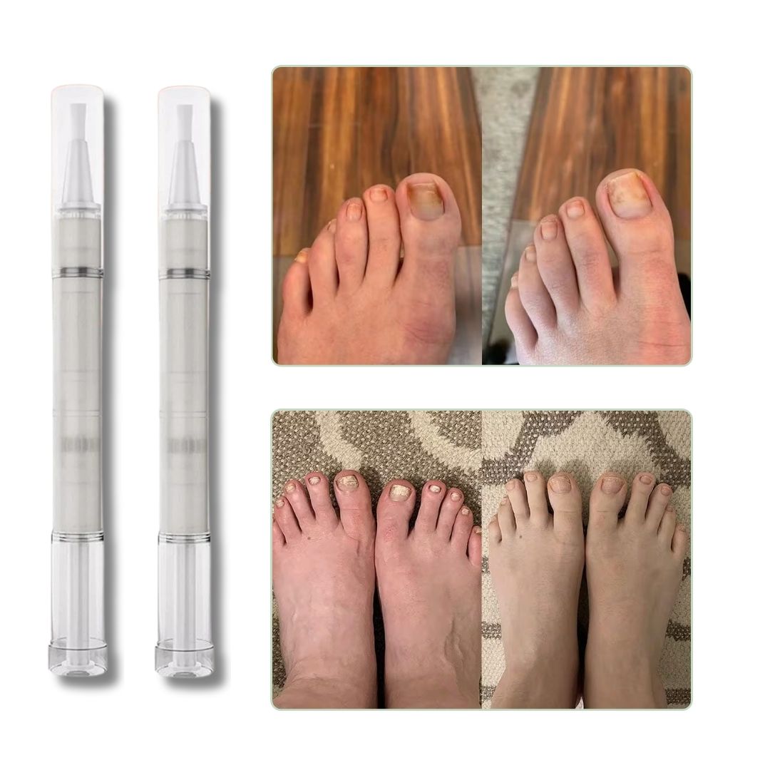 Toenail fungus serum in a slim applicator pen for brushing onto the nail