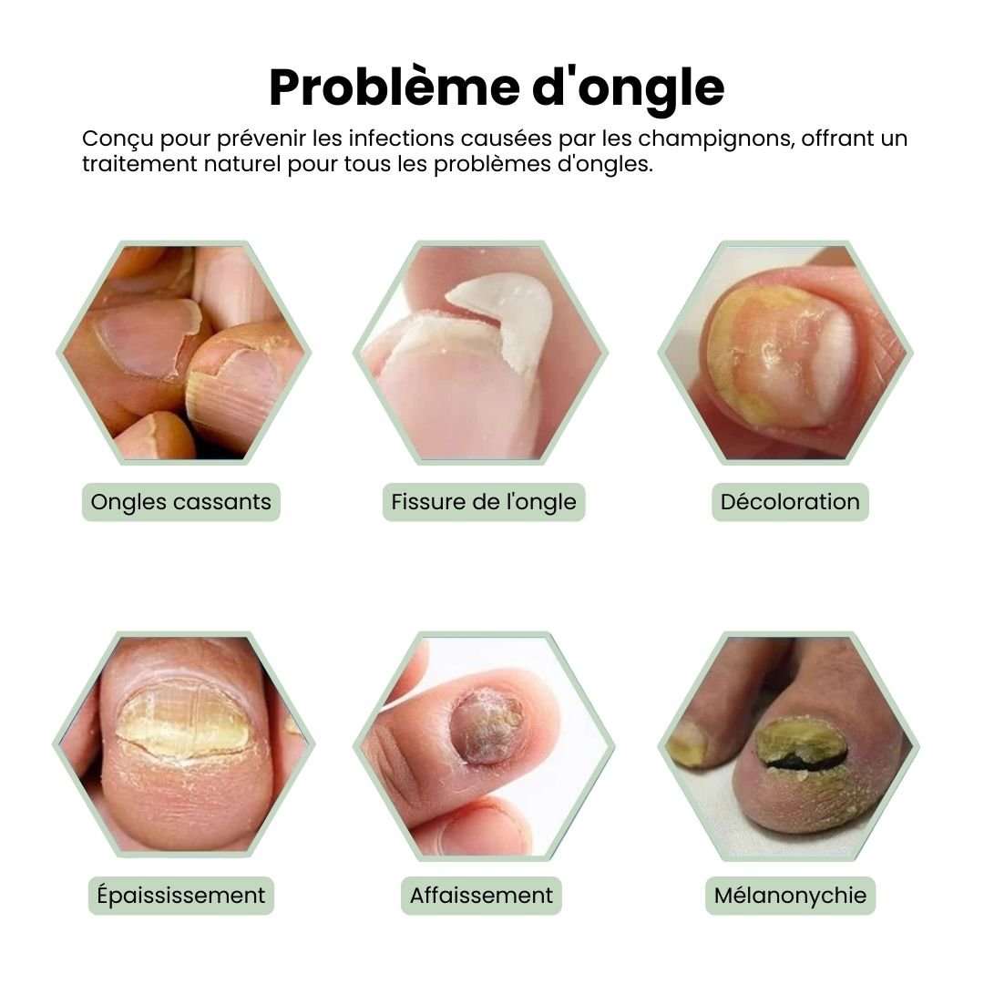Handheld laser pen held over the toenail to treat nail fungus at home