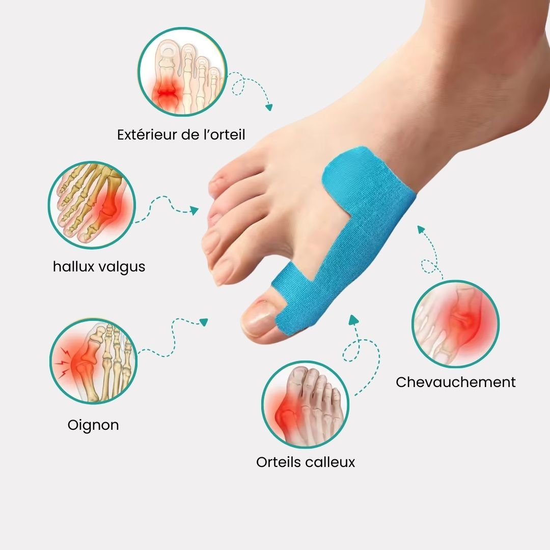 Sky blue elastic bunion tape strips applied along the side of the big toe