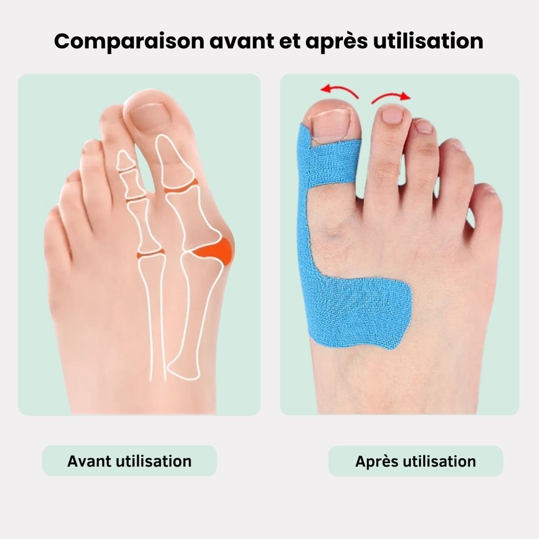 Sky blue elastic bunion tape strips applied along the side of the big toe
