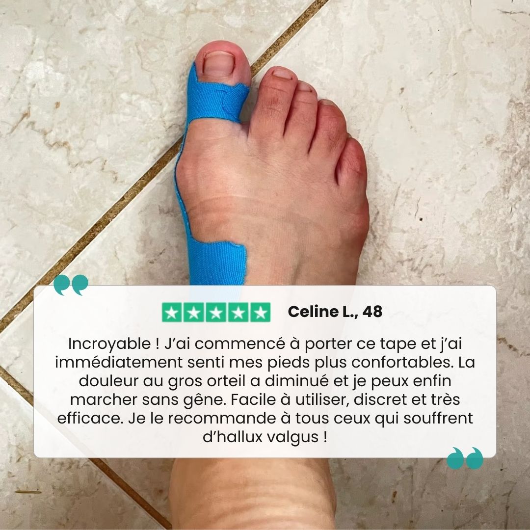 Sky blue elastic bunion tape strips applied along the side of the big toe